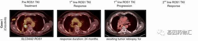 2年又2年,长期生存竟如此轻而易举!选对了药,肺癌并没有那么可怕