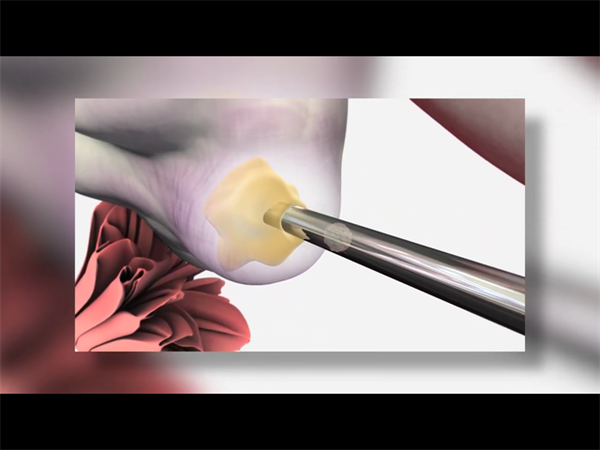 影响高龄三代试管费用的五大关键因素，助你精准预算