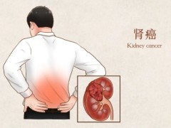 肾癌的查出方法具体有哪些？揭晓肾癌的临床表现