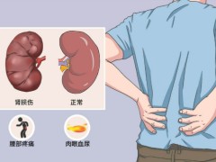 肾癌康复运动有哪些？附肾癌的饮食治疗原则