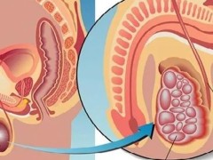 科学预防睾丸癌方法介绍！睾丸癌死亡率高吗