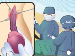睾丸癌是如何形成的？睾丸癌发作的治疗方法都有哪些