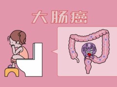 如何做大肠癌检查？大肠癌应该如何治疗