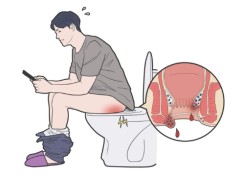 肛门癌是一种什么病？肛门癌早期治愈率高不高