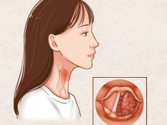 喉癌的诊断是怎样的？喉癌常见的4种类型