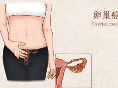 得了卵巢肿瘤怎么办？附手术治疗恶性卵巢肿瘤的方法