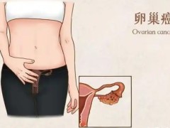 卵巢肿瘤会不会影响女人生育？女性如何预防卵巢肿瘤出现