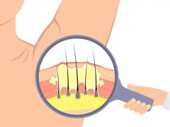 汗腺癌是什么原因引起的？汗腺癌的存活率高吗