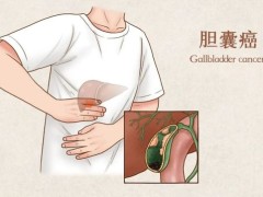 胆囊癌的症状具体有哪些？附胆囊癌治疗常用药物一览