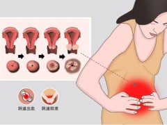 宫颈癌有遗传史吗？宫颈癌适合什么运动
