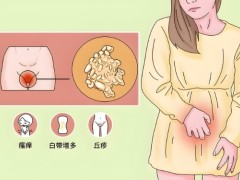 宫颈癌早期症状容易引起混淆！感染HPV并不一定得宫颈癌