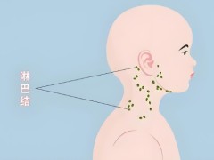 淋巴癌都有什么症状？淋巴癌是怎么引起的