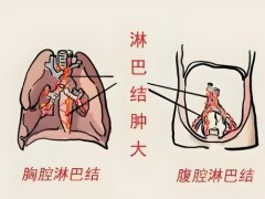 早期有什么方法能检查出淋巴癌？来听听专家的介绍吧